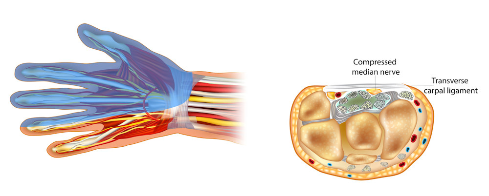 What is carpal tunnel syndrome?